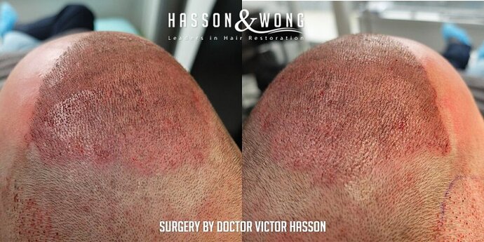 Dr. Hasson / 4,511 grafts / FUE / Frontal zone /mid / 3 years post-op photo