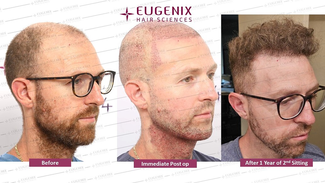 https://cdn.forumhairtransplant.com/optimized/3X/c/1/c1b91f19c441a0e743305fba54aa7e51b79a8331_2_1035x582.jpeg