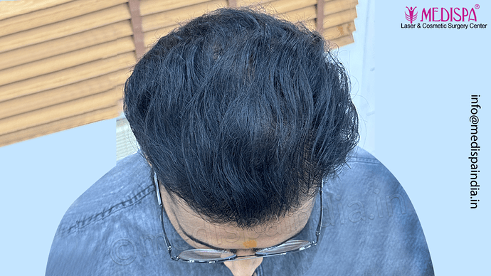 Dr. Suneet Soni - 5467 Grafts, Combine FUT + FUE + Beard Technique, NW- V, 3 Years Result photo