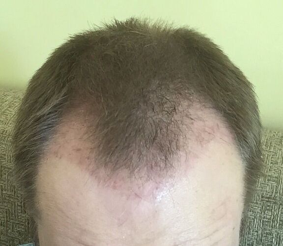Dr. Bisanga, 2382 FUE. 0-12 Months. BHR Clinic photo