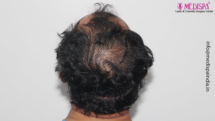 Dr. Suneet Soni - 5000 Grafts, Combine FUT + FUE + Beard Technique, NW-V photo