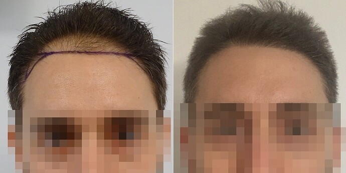 DR. BISANGA - BHR CLINIC / 2405 FUE HAIR TRANSPLANT photo