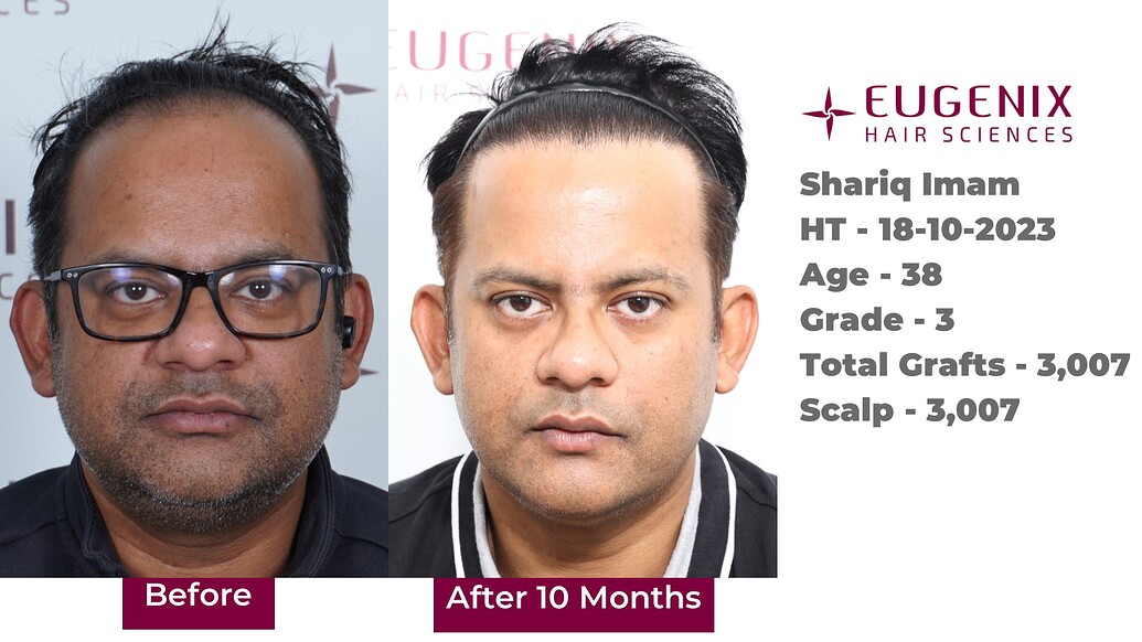 https://cdn.forumhairtransplant.com/optimized/3X/c/2/c289df759ed2dc7a54b293756f30247df2613e61_2_1035x582.jpeg