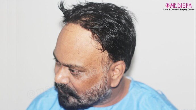 Dr. Suneet Soni - 4190 Grafts, Combine FUT + FUE + Beard Technique, NW- III photo