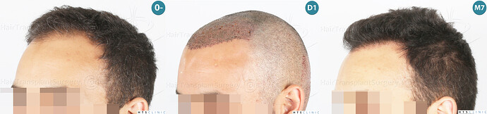 Dr Devroye + Dr Montesanti + Dr Jenard, HTS Clinic / 2018 FUE / Hairline & frontal area photo