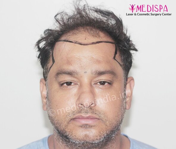 Dr. Suneet Soni - 5000 Grafts, Combine FUT + FUE + BHT (Beard) Technique, NW-V, 2.5 Year Result photo