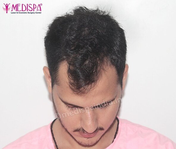 Dr. Suneet Soni - 2500 FUE Grafts, NW- III photo