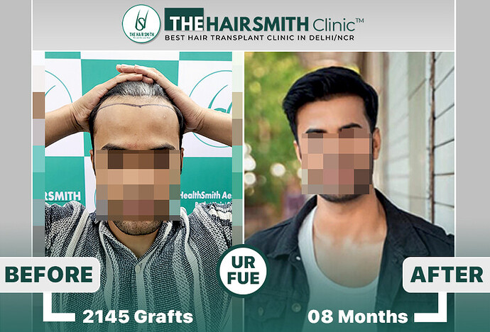 The HairSmith Clinic™ | NW Stage 3 | 2145 Grafts | 8 Months Hair Transplant Result photo