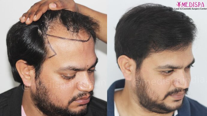 Dr. Suneet Soni - 4937 Grafts, Combine FUT + FUE Technique, NW : IV-V photo