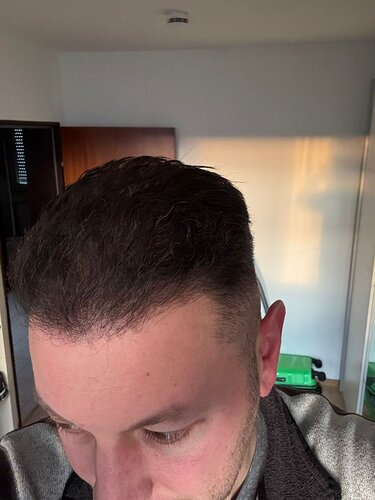 Ozlem Bicer MD-Hair Transplant-2910 Grafts FUE by micro-motor, 7. months result photo