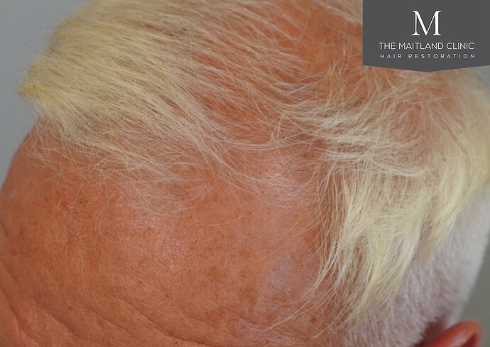 Dr Ball - The Maitland Clinic 2280 Grafts by FUE photo