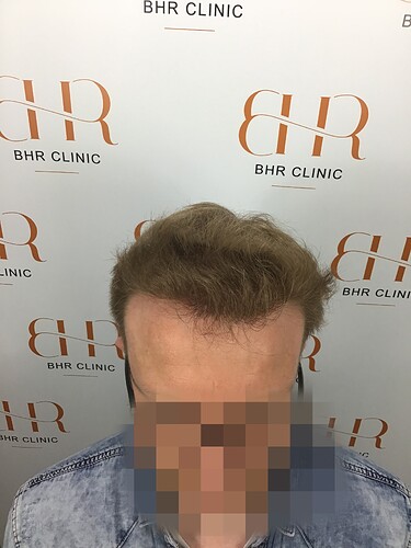 Dr. Bisanga BHR Clinic - 3001 FUE 0 - 15 Months - Fine Blond Hair photo