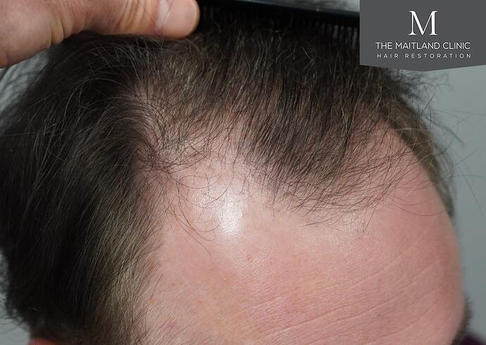 Dr Ball - The Maitland Clinic 2032 Grafts By FUE photo