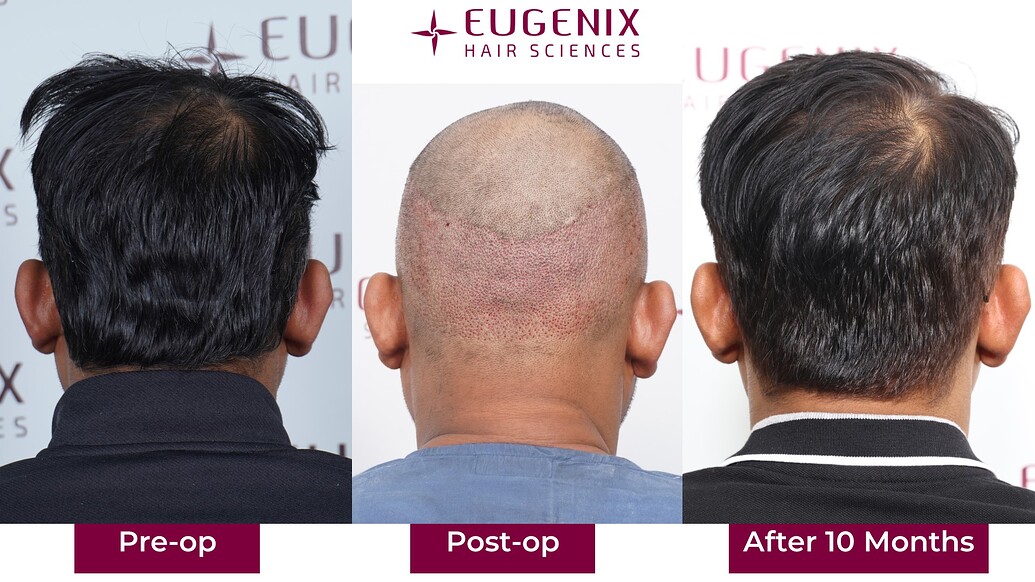 https://cdn.forumhairtransplant.com/optimized/3X/c/4/c45cd6074f9b17776f4ba08cf791ac76781204ed_2_1035x582.jpeg