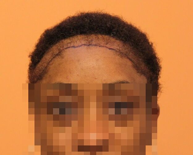 Dr. Bisanga, BHR Clinic, 2001 FUE / 0-8 Months. Female case photo