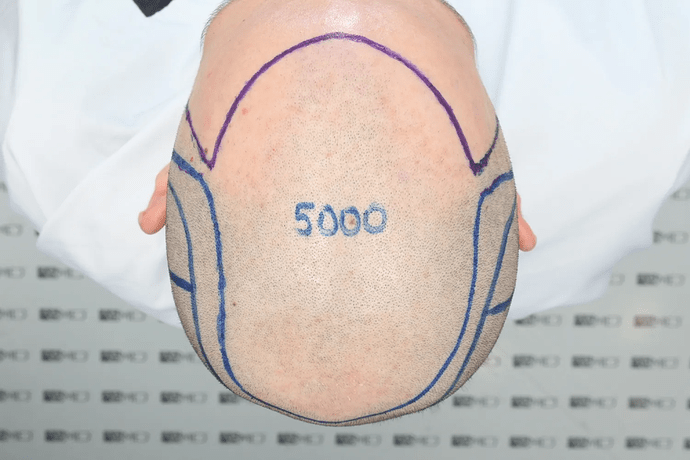 ASMED, Istanbul: 5,071 Manual FUE Grafts 0/12 Months photo
