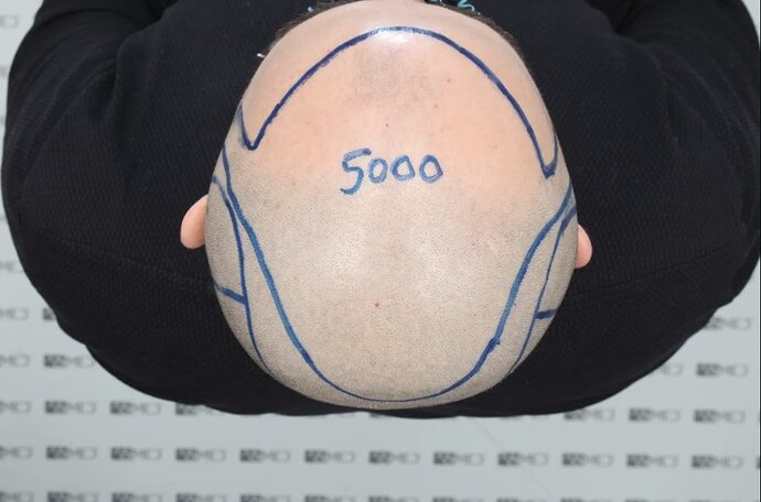 ASMED CLINIC - DR.KORAY - 5060 GRAFTS FUE photo