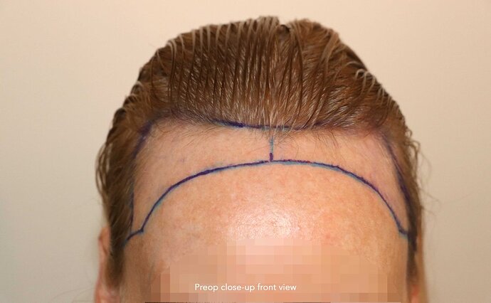Case performed by Dr. Feriduni – 2423 FU in 1 procedure photo