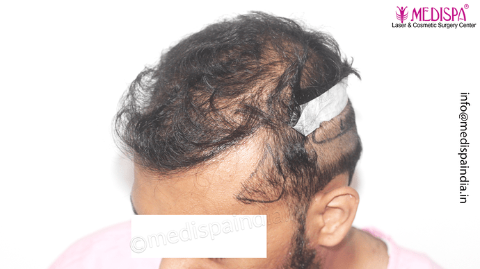 Dr. Suneet Soni - 4665 Grafts, Combine FUT + FUE + BHT (Beard) Technique photo