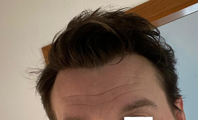 Hairline FUE Result for 2500 Grafts – 8 Months After – HDC Hair Clinic photo