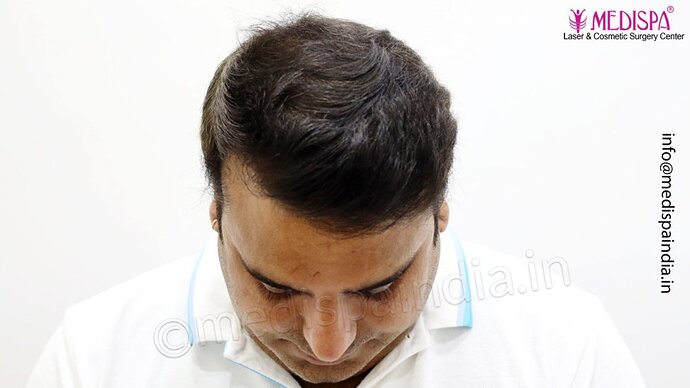 Dr. Suneet Soni - 4500 Grafts, 3 Year Result, NW-IV, Combine FUT + FUE Technique photo