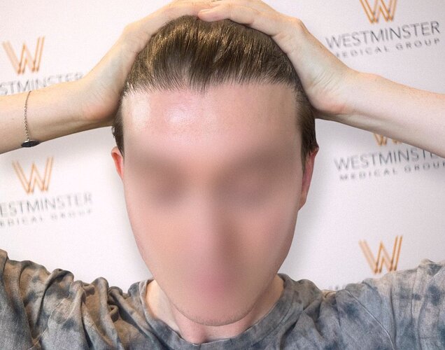 Westminster Medical Group London - 1562 Grafts - 12 Months Progress photo