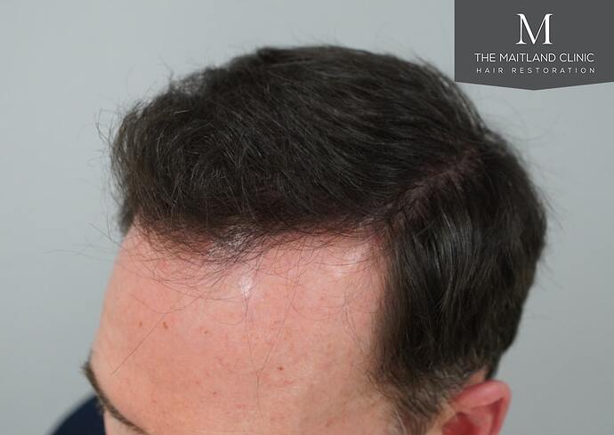 Dr Ball - The Maitland Clinic 1432 Grafts By FUE photo