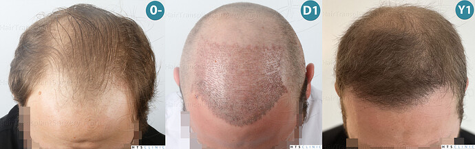 Dr. Jean Devroye, HTS Clinic / 3054 FUE / Hairline & front-mid restoration photo