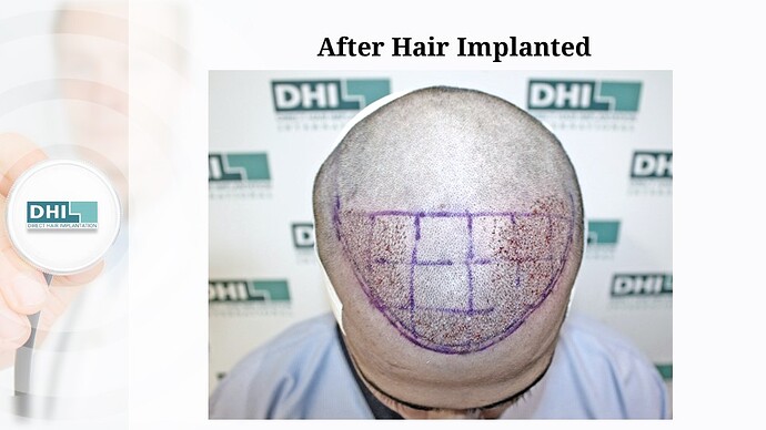 DHI India | NW 2 | 1,359 Grafts | 7-Months DHI Hair Transplant Results photo