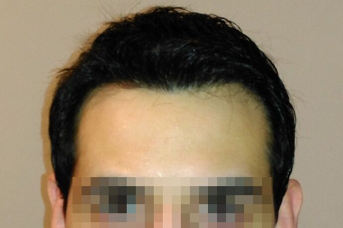 Dr.Bisanga, BHR Clinic, 2988 FUE 0 - 12 Months photo