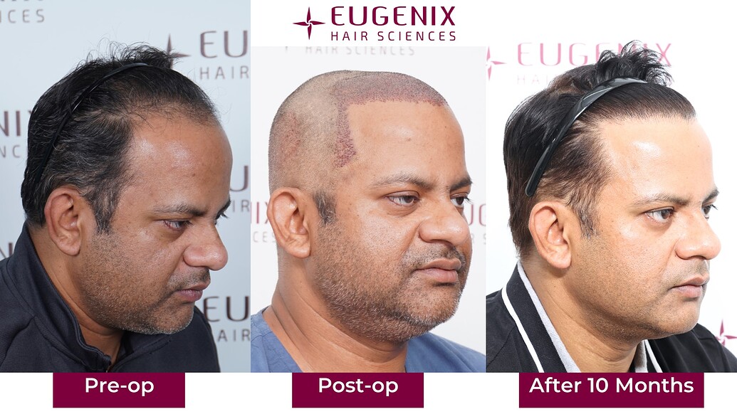 https://cdn.forumhairtransplant.com/optimized/3X/c/5/c5df9d693b87ef63e05e22960d578161a61aad39_2_1035x582.jpeg