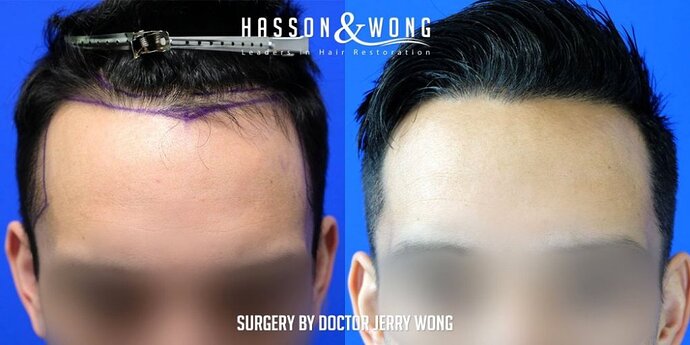 FUE Hair Transplant with Dr. Wong /1300 Grafts/ Hairline/temple points/ 1 Session/ 1 year post-op photo