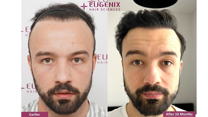 Dr. Somesh| Eugenix Hair Sciences Clinic | NW 3 | 3007 Grafts | 10 Months Post-op photo