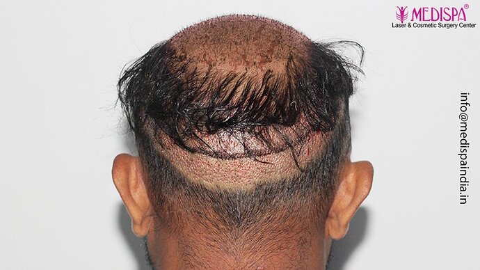 Dr. Suneet Soni - 5498 Grafts, 2 Years Result, Combine FUT + FUE + Beard Technique, NW-VI photo