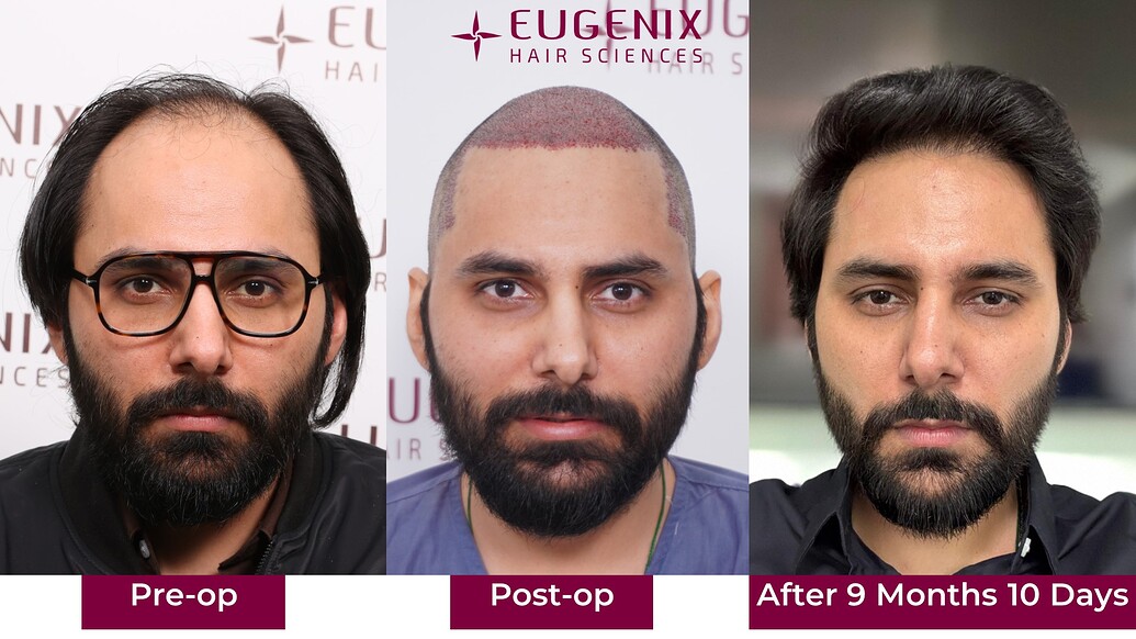 https://cdn.forumhairtransplant.com/optimized/3X/c/6/c67c4dfe0f2149608f8284b8ece179876009473c_2_1035x582.jpeg