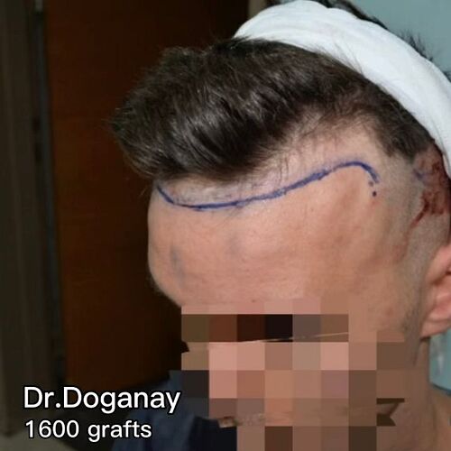 DR HAKAN DOGANAY/ 1600 GRAFTS / Implanter Pen+FUE photo