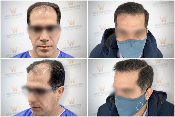 Westminster Medical Group London - 4700 Grafts - 12 Months Progress photo