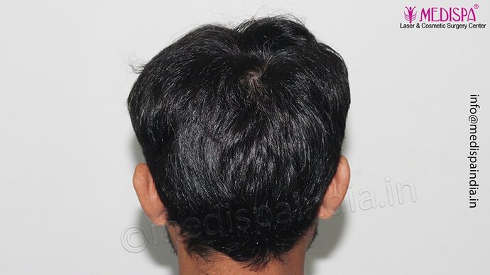 Dr. Suneet Soni - 3029 FUE Grafts, FUE Method (Trivellini System), NW - III photo