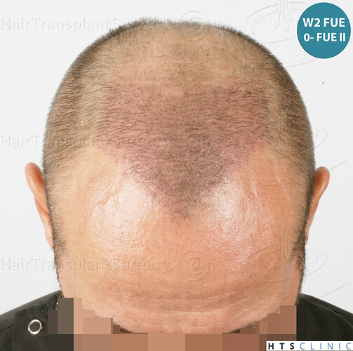Dr. Jean Devroye, HTS Clinic / 5280 FUE (2008 + 2018 + 1254) / 3 sessions photo