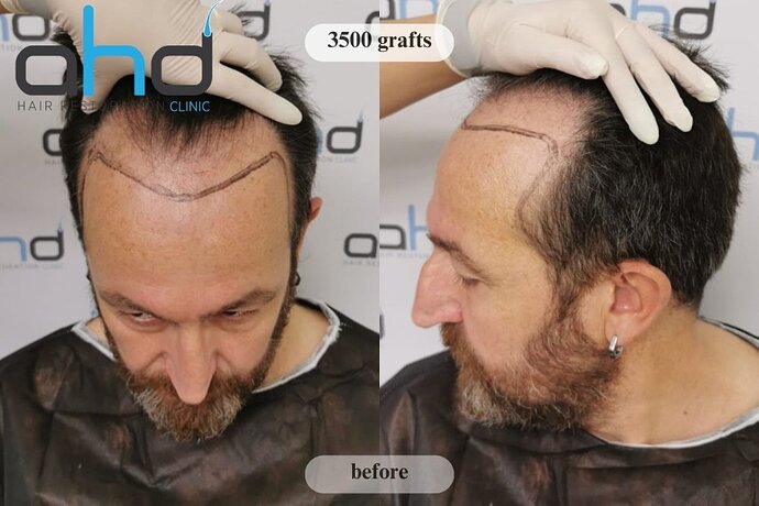 AHD Clinic / Dr.Hakan Doganay's Team / DHI + FUE/ 3500 grafts photo