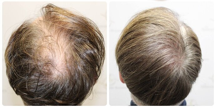 Dr Bonaros, Glasgow, UK / 3207 FUE grafts / 0-12 Months photo