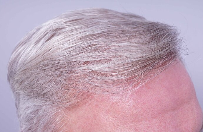 Dr B Farjo 1750g FUE to frontal recessions. photo