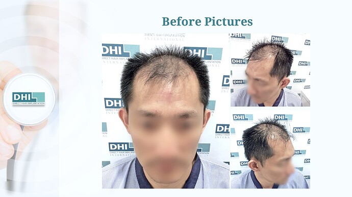 DHI India | NW 5 | 5,319 Grafts | 7-Months DHI Hair Transplant Results photo