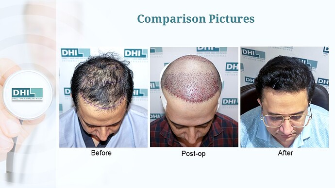 DHI India™ | NW 5 | 3,323 Grafts | 1 Year Hair Transplant Result photo