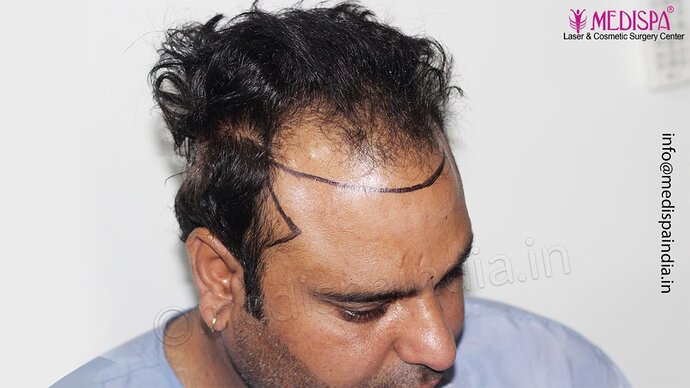 Dr. Suneet Soni - 4500 Grafts, 3 Year Result, NW-IV, Combine FUT + FUE Technique photo