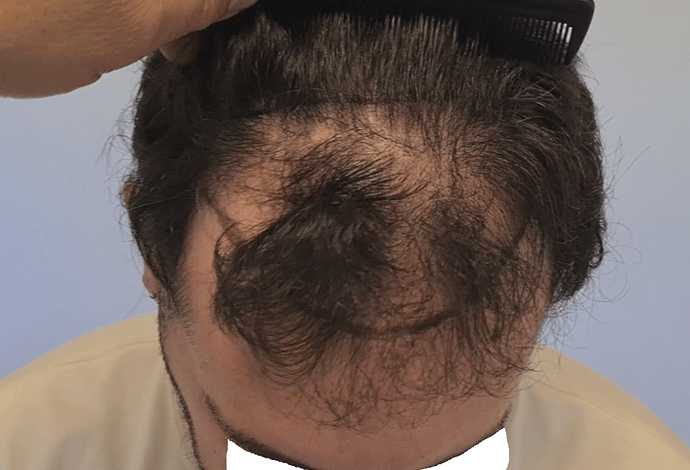 Result of NW3 patient after 3230 grafts after 7 months – HDC Hair Clinic – Dr Christina photo