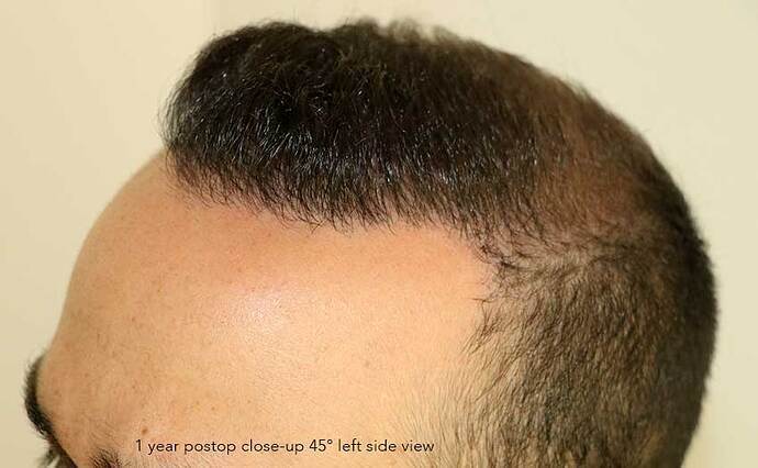Case performed by Dr. Feriduni – 3505 FU in 1 procedure photo
