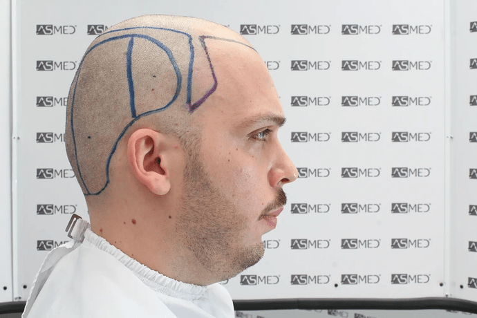 ASMED, Istanbul: 5,071 Manual FUE Grafts 0/12 Months photo
