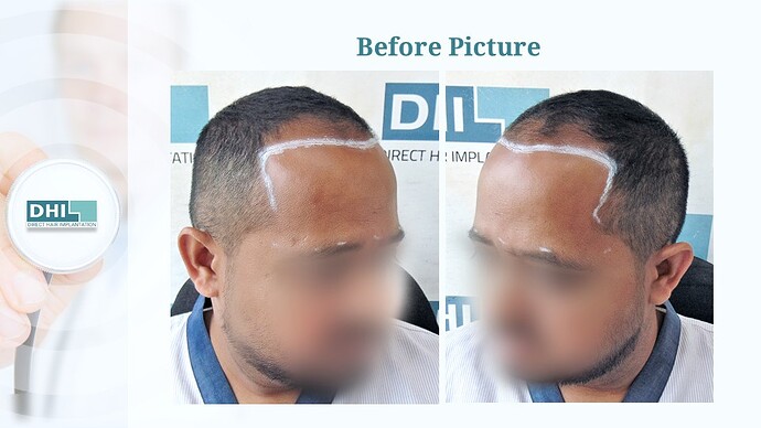 DHI India™ | NW 3 | 3,506 Grafts | 7 Months Hair Transplant photo
