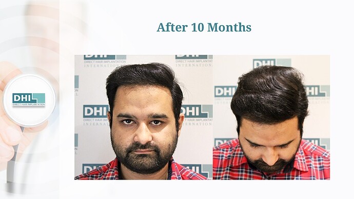 Full Scalp Coverage – 3,636 Grafts | DHI India Result photo